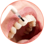Фторирование зубов в спб