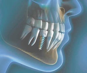 как выглядит имплант зуба