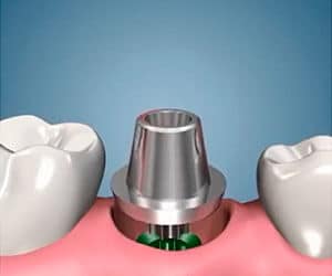 Классическая двухэтапная имплантация зубов