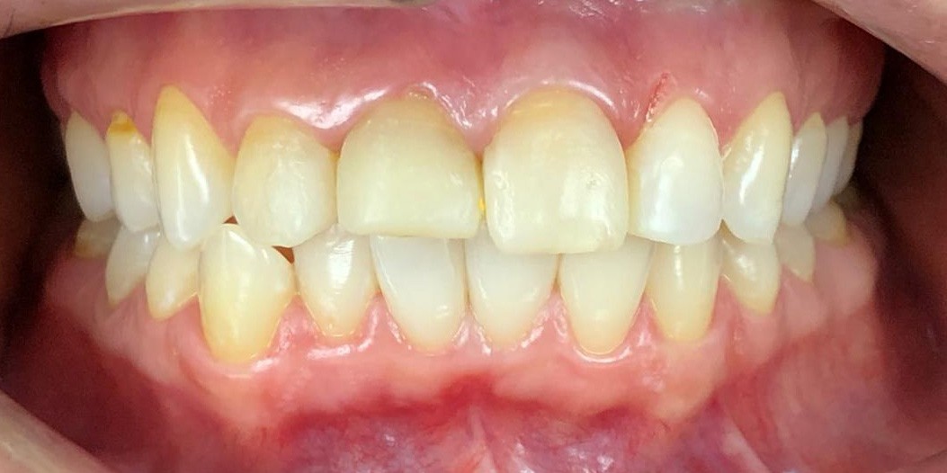 Реставрация зубов емакс до