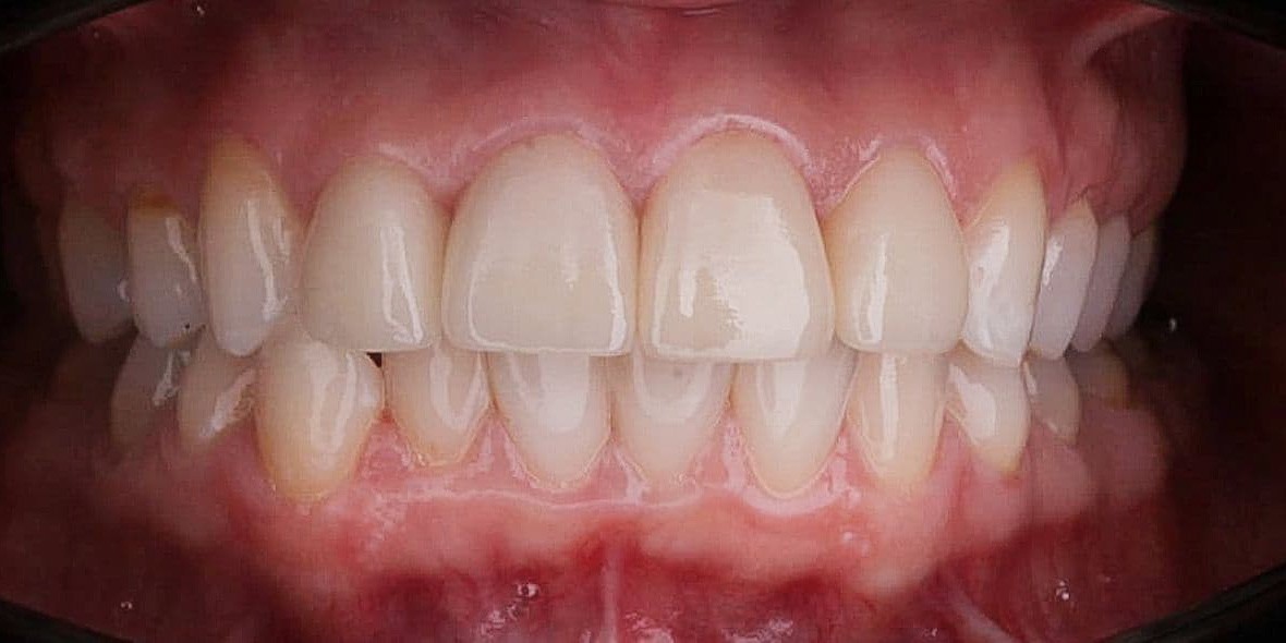 Реставрация зубов emax фото после