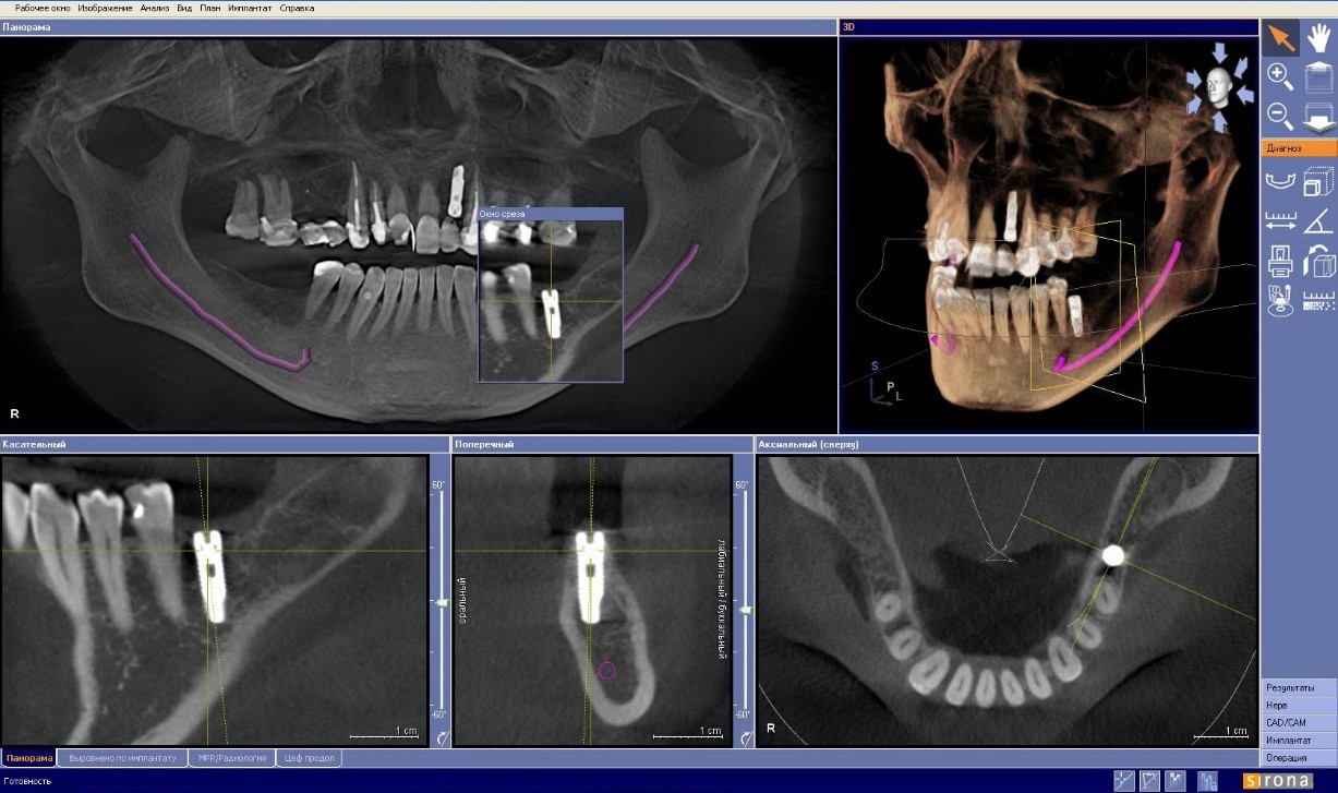 3d КТ снимок при имплантации верхних зубов