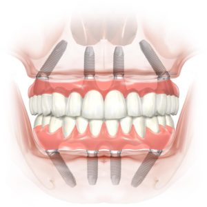 Цена имплантации переднего зуба верхней челюсти под ключ