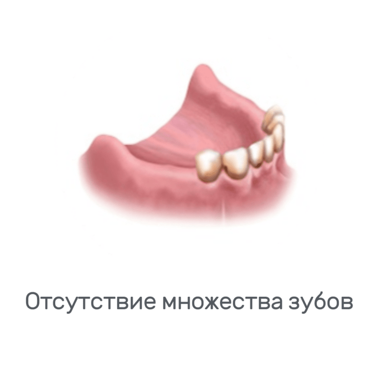Имплантация нижней челюсти - нет много зубов