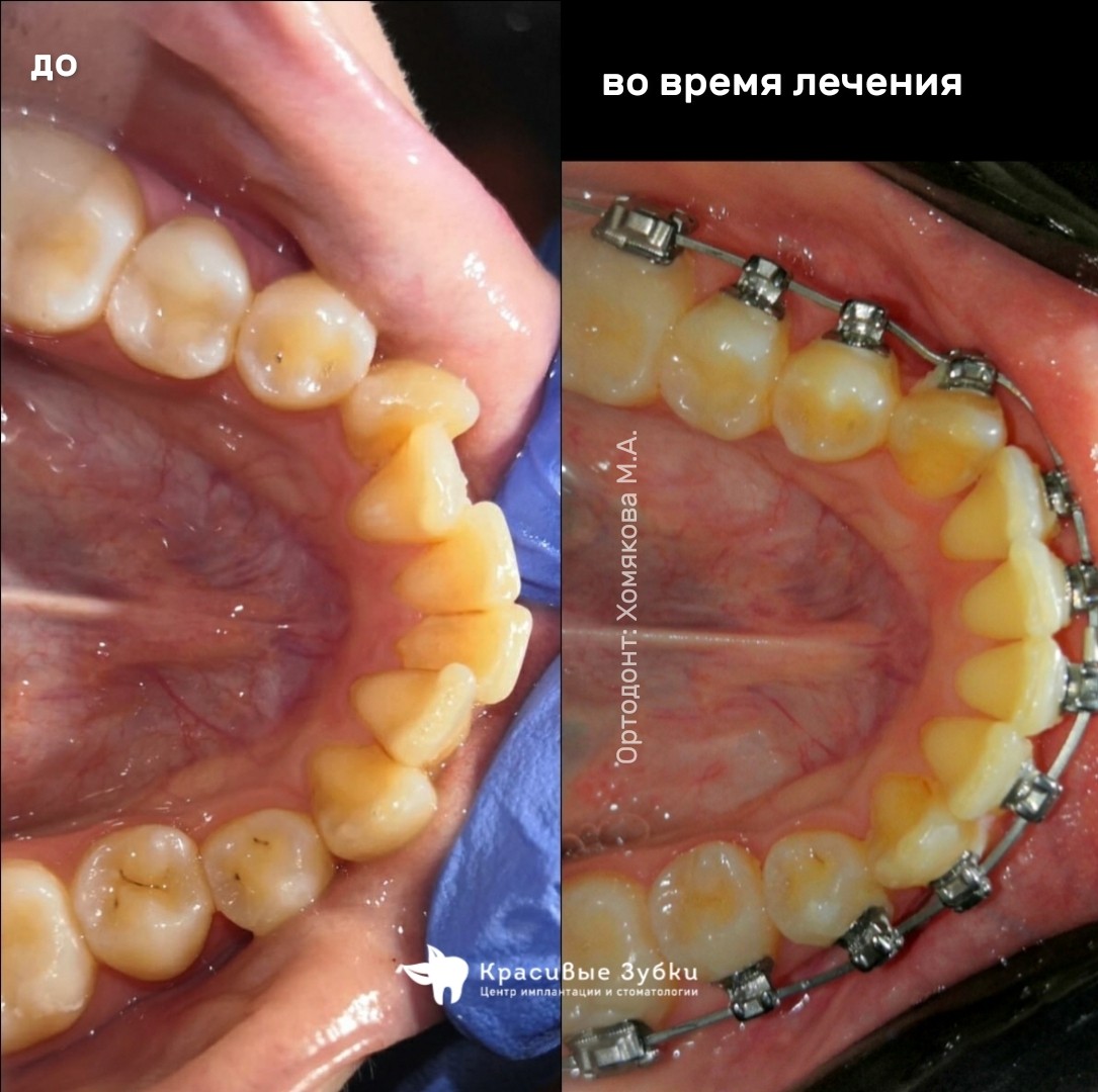 Пример работ по ортодонтии 9