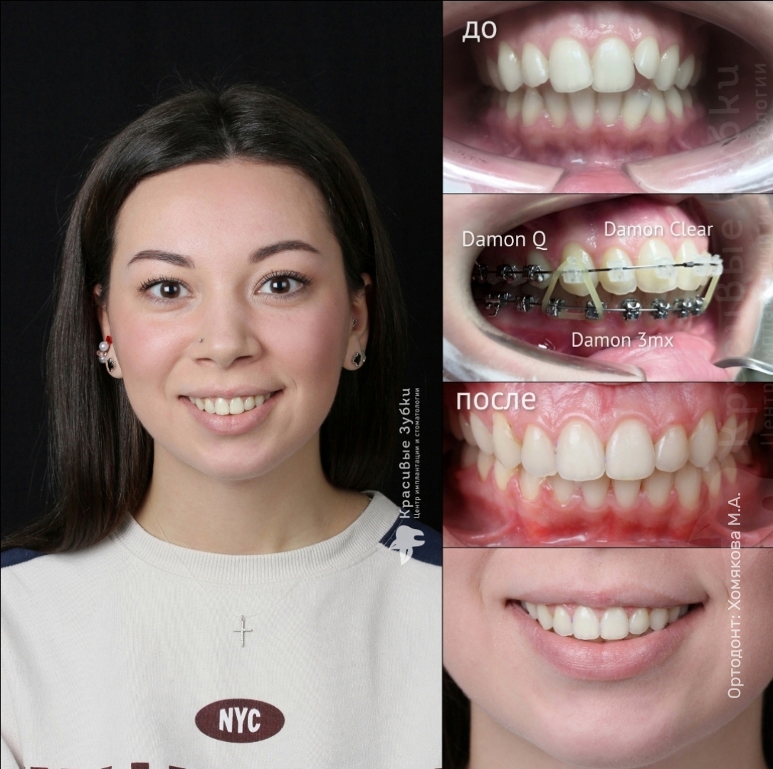 Пример работ по ортодонтии 8