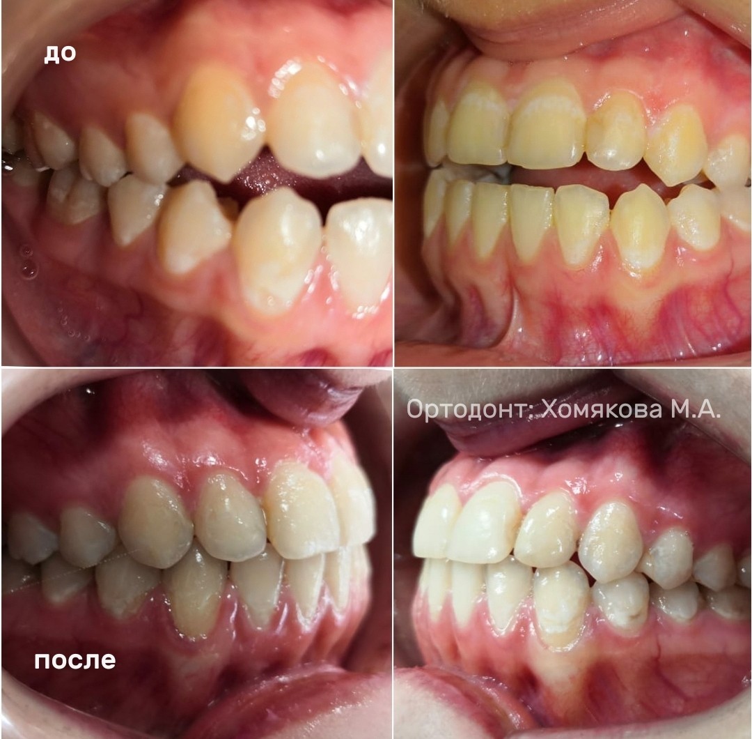 Пример работ по ортодонтии 4