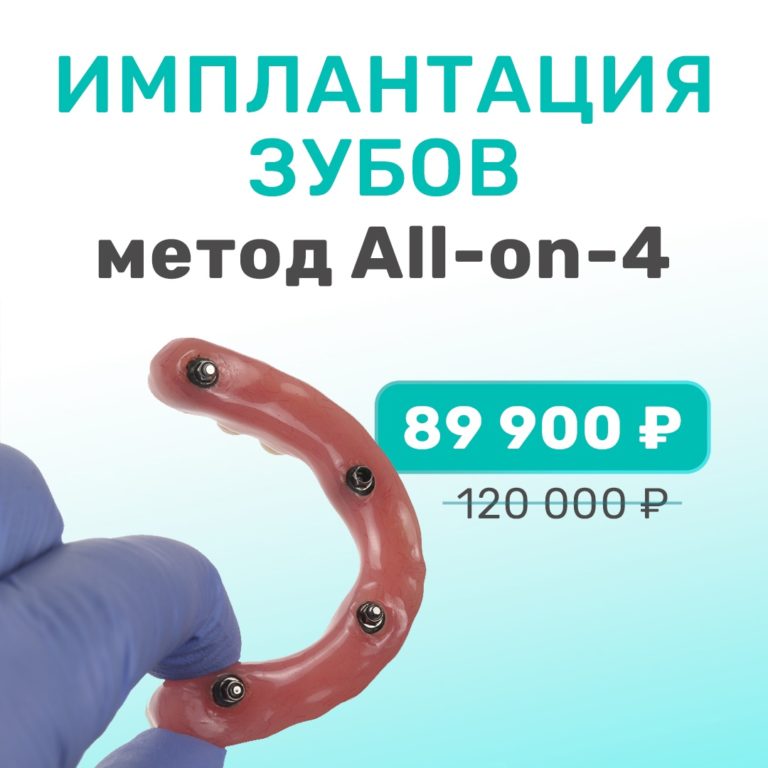 имплантация зубов по методу все на 4х