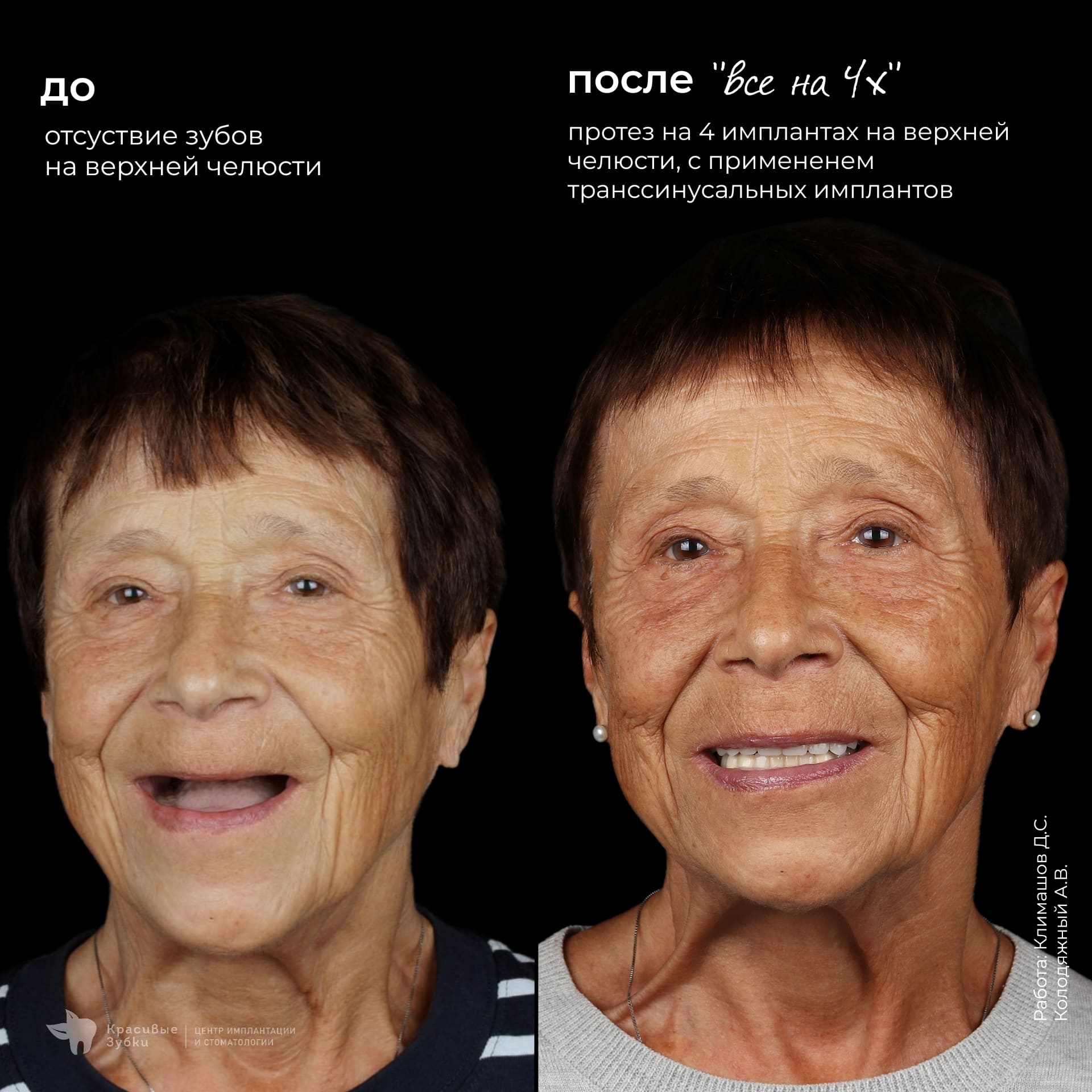 Имплантация верхней челюсти методом Всё на 4 — до и после