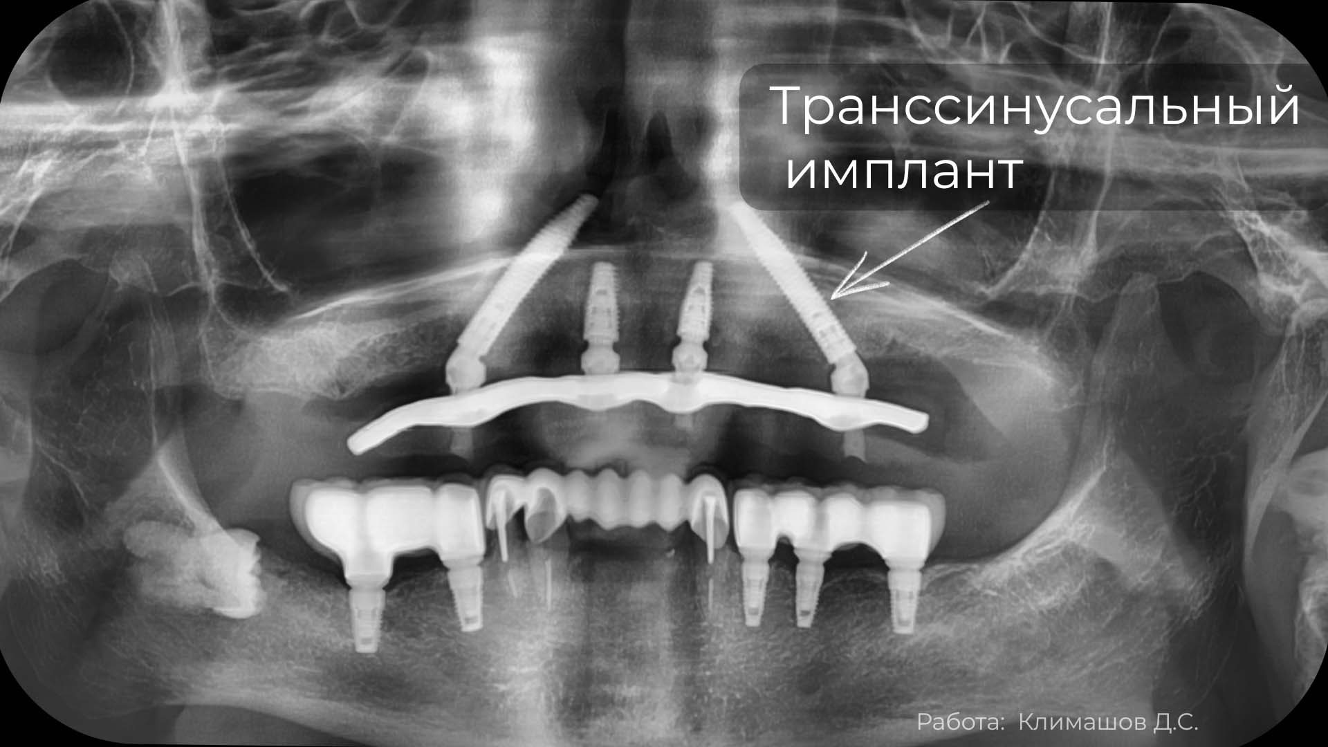 ОПТГ после имплантации Всё на 4 — четыре импланта на верхней челюсти