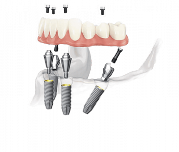 имплантация зубов в СПб -установка зубов на всю челюсть