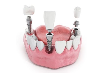 имплантация зубов в СПб -несколько зубов
