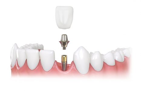 имплантация зубов в СПб -1 зуб